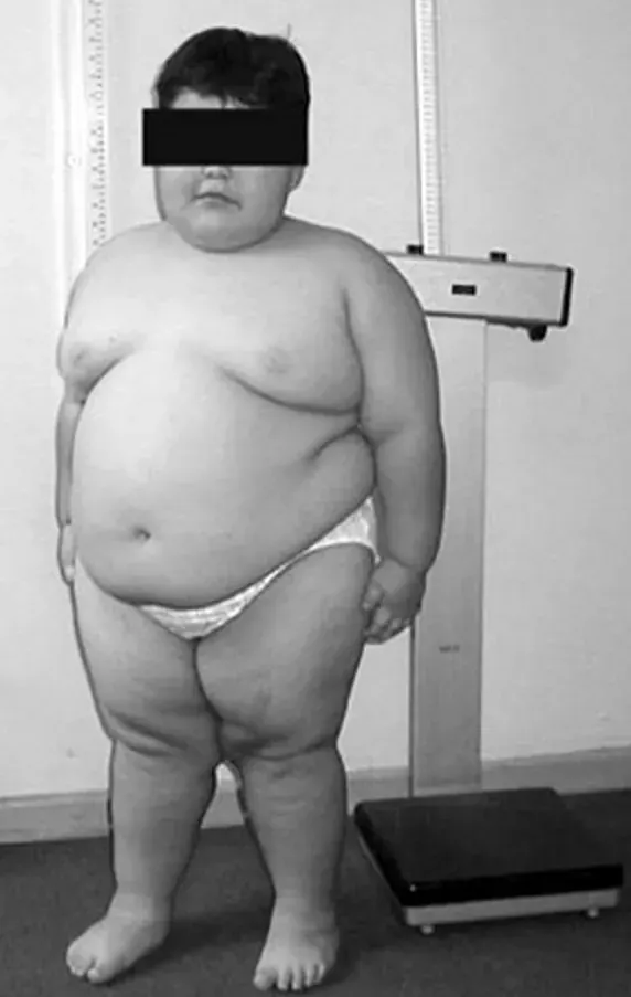 The Prader–Willi syndrome card