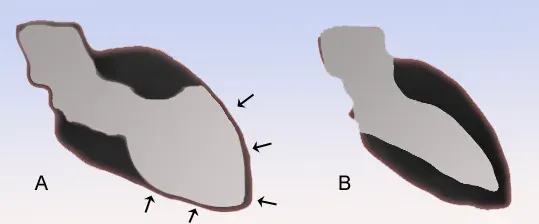 La carte Syndrome de tako-tsubo