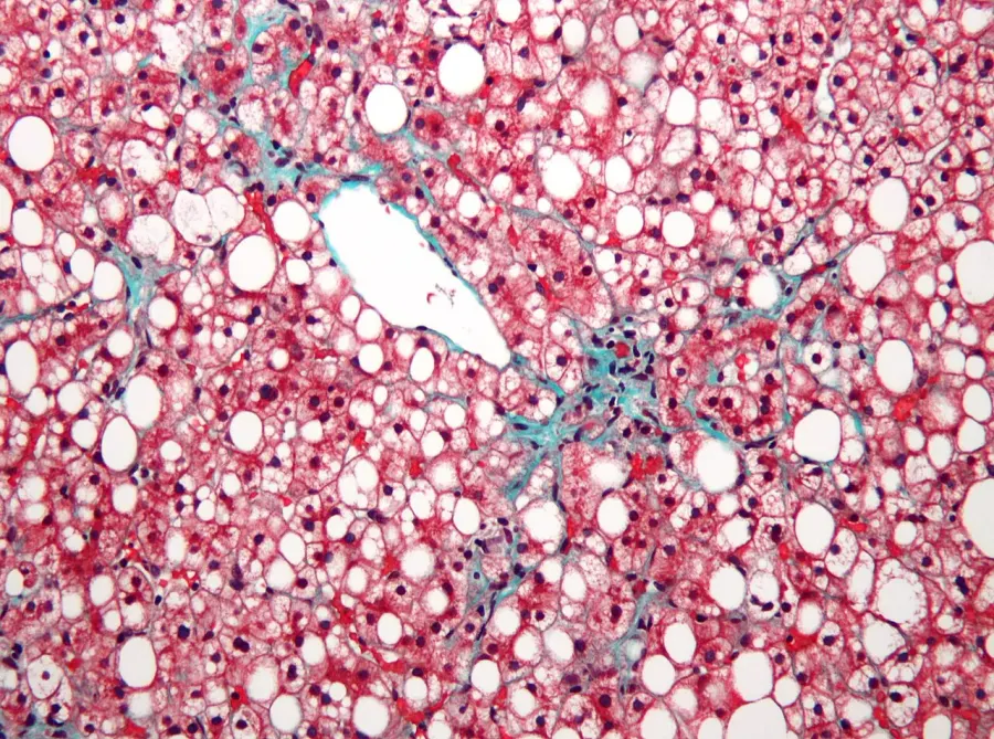 The Fatty liver disease card