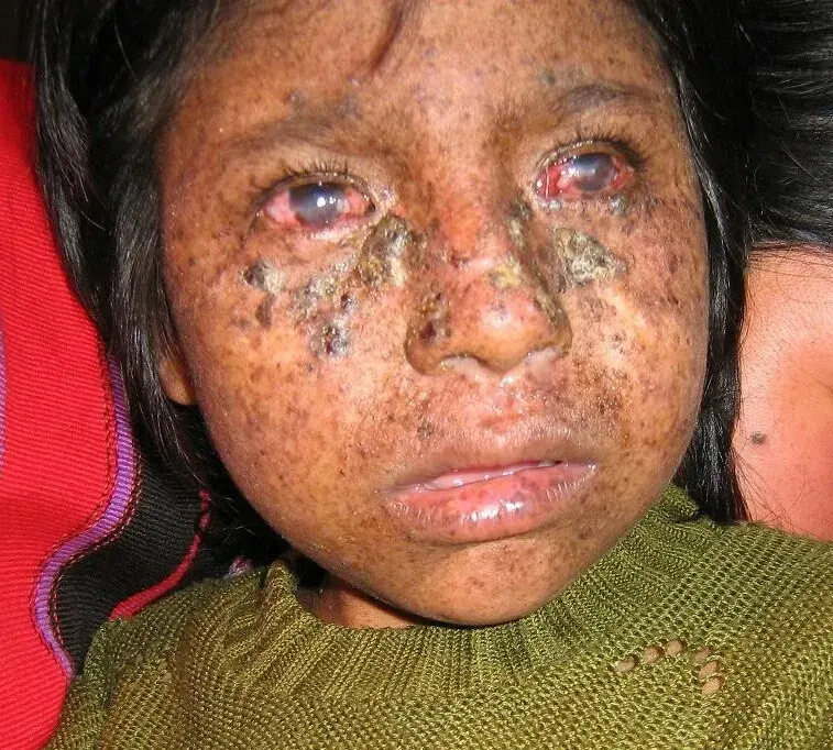 The Xeroderma pigmentosum card