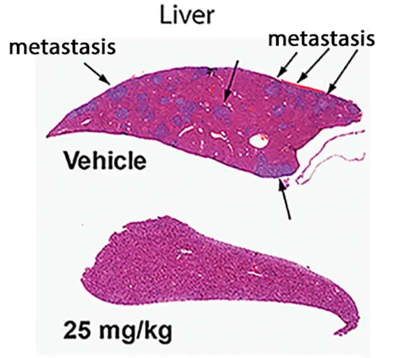 The Liver cancer card