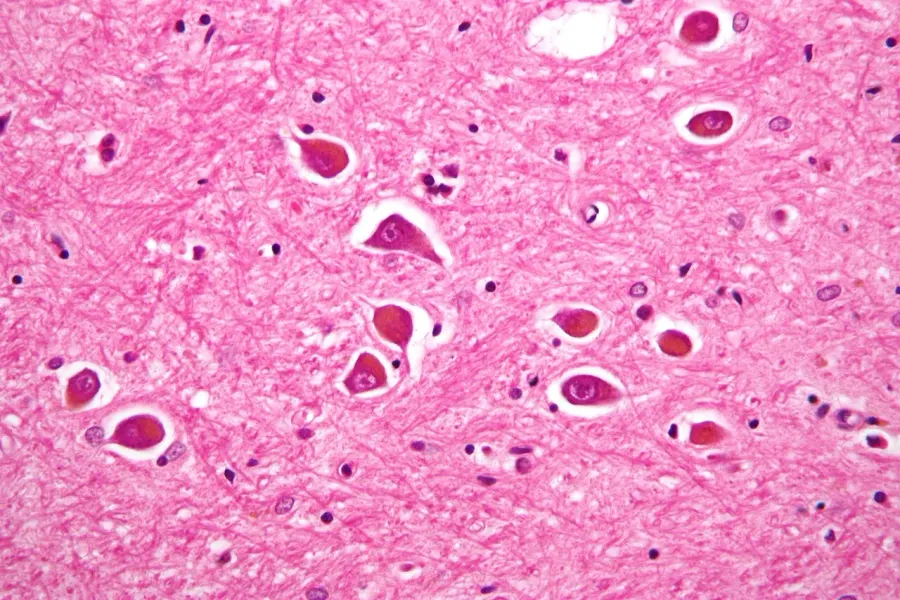 The Hepatic encephalopathy card