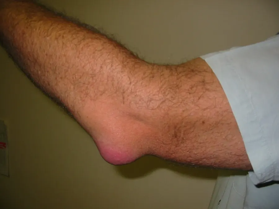 The Bursitis card