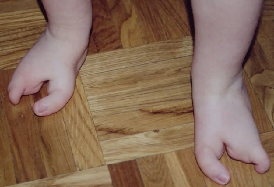 The Ectrodactyly card