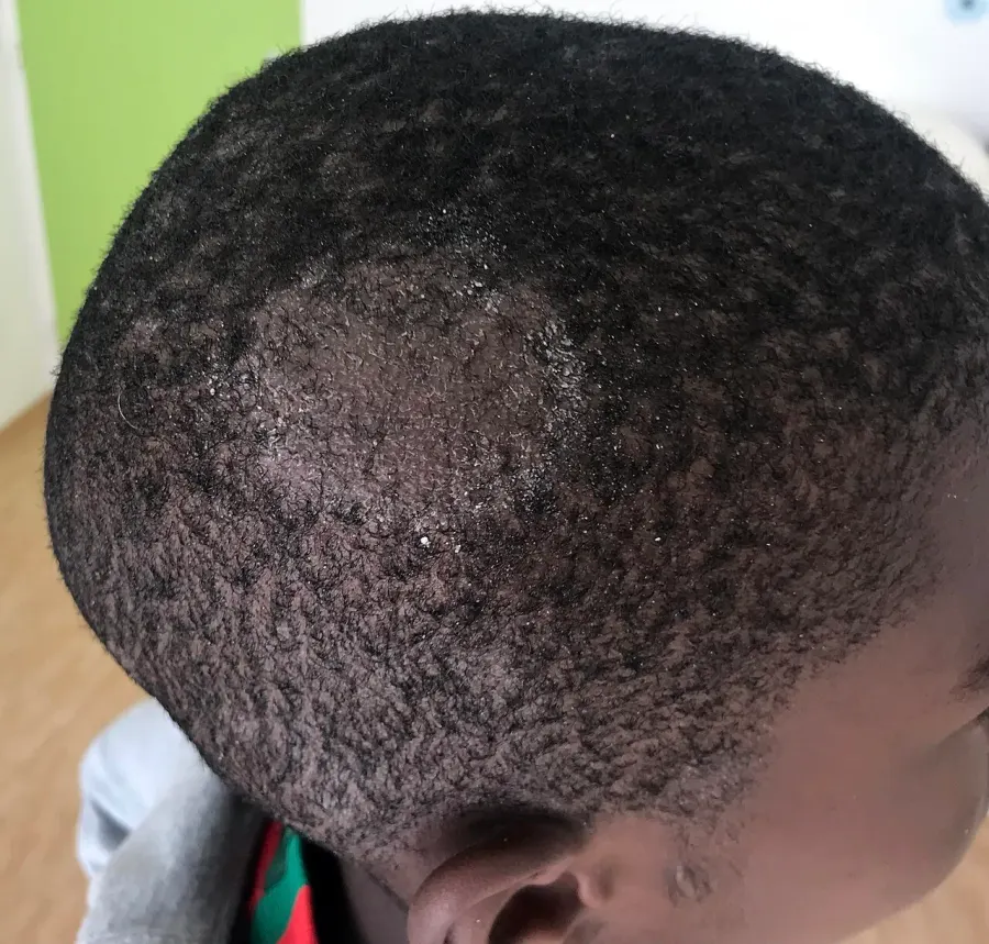 The Tinea capitis card