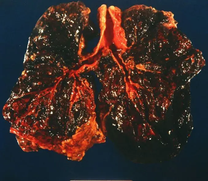 La carte Pneumoconiose