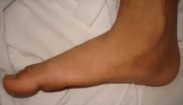 La carte Pied plat