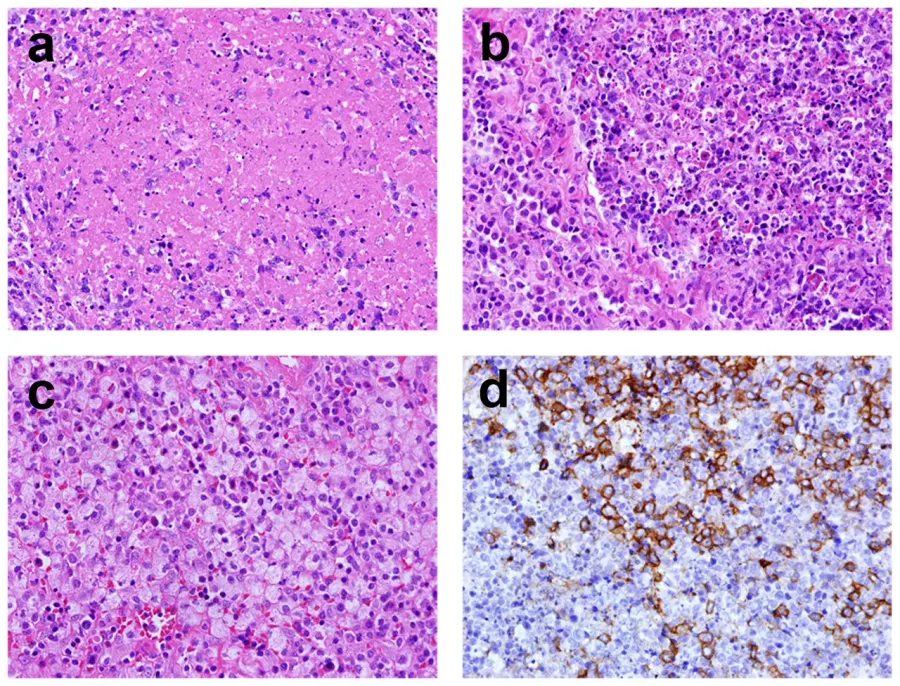 The Histiocyte card
