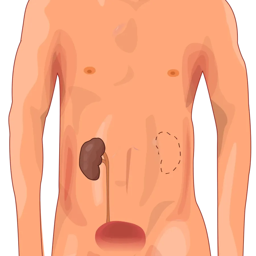 The Renal agenesis card