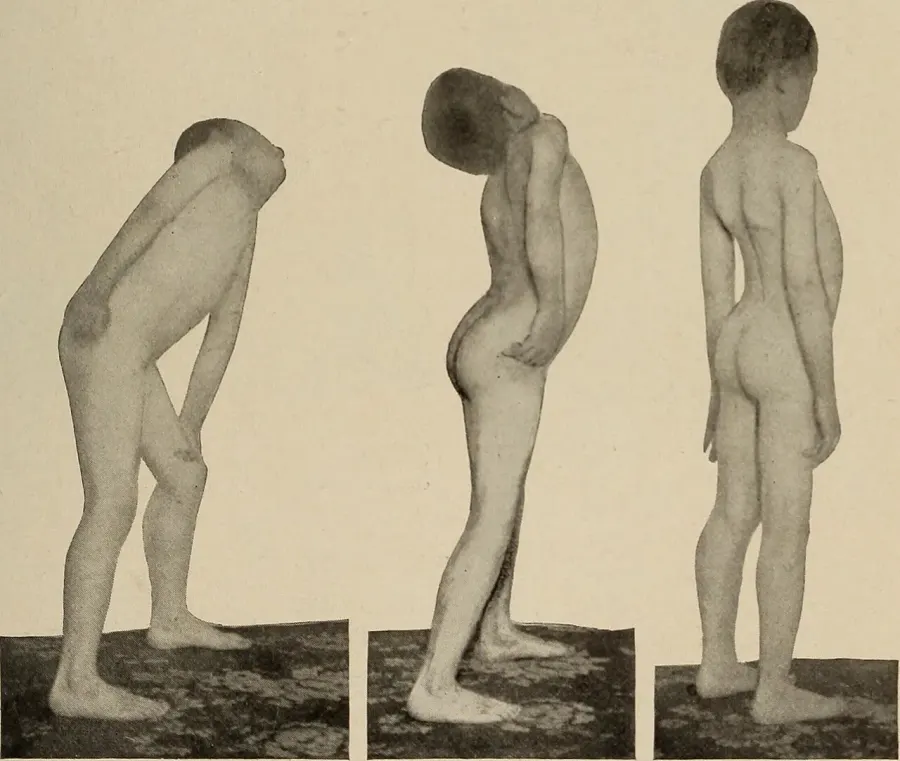 The Myopathy card