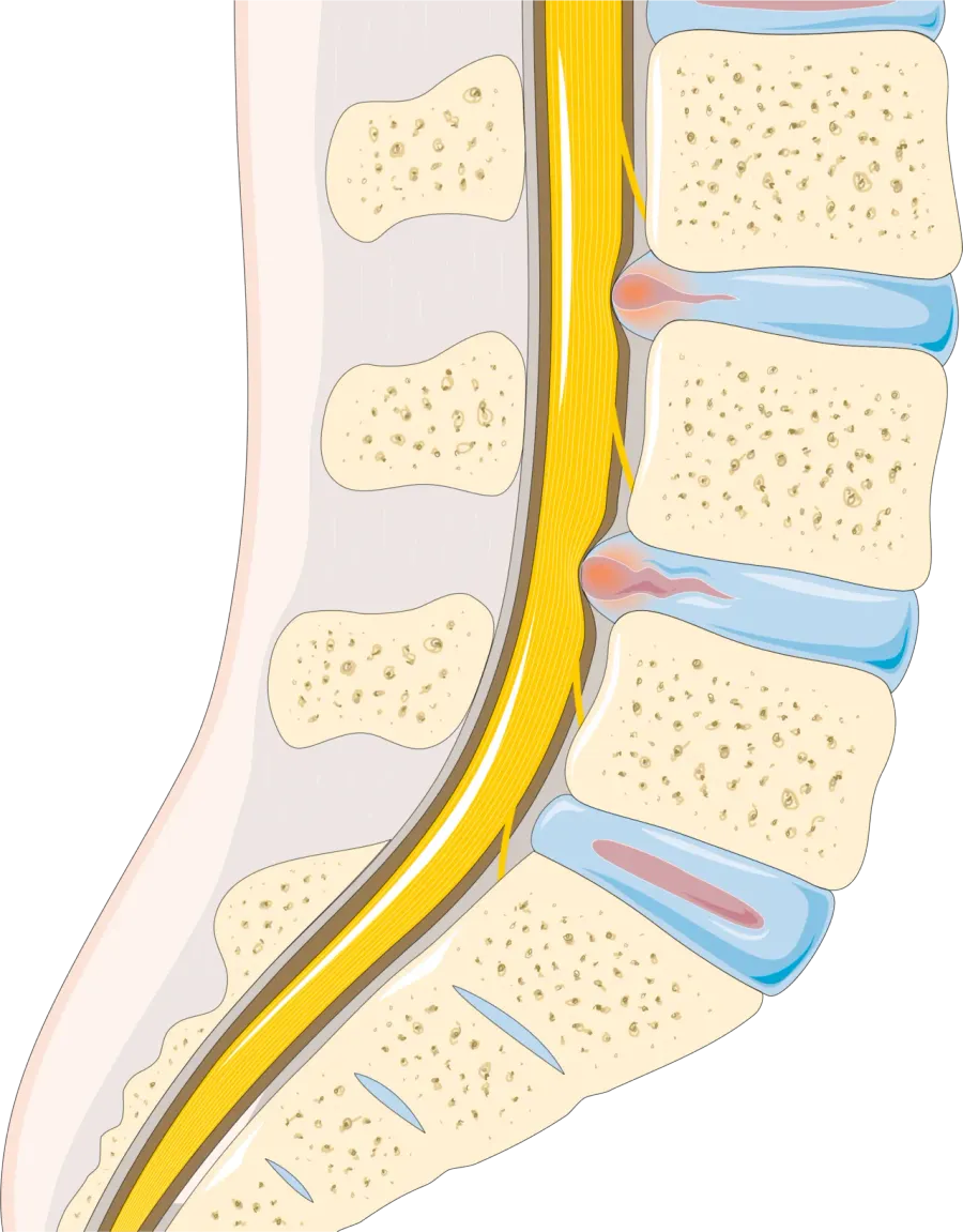 The Disc herniation card