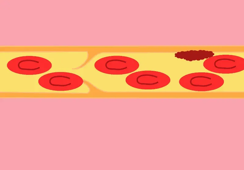 The Coronary thrombosis card