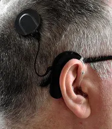 La carte Implant cochléaire