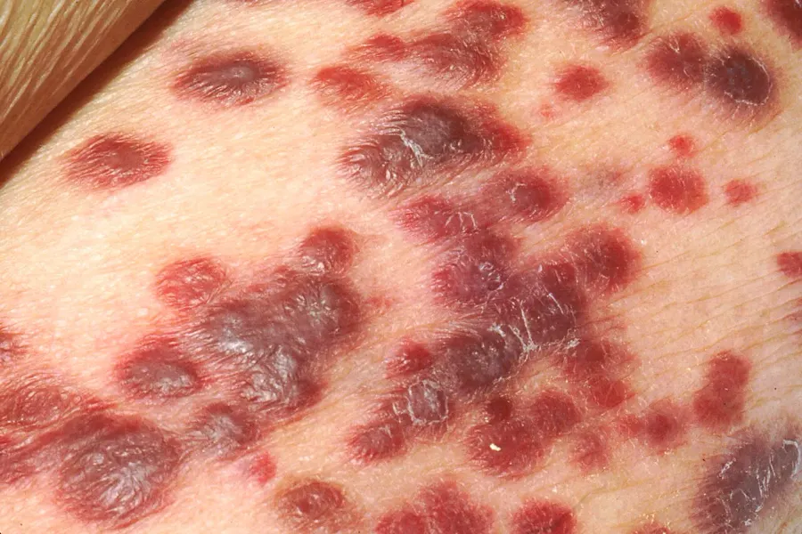 The Kaposi's sarcoma card
