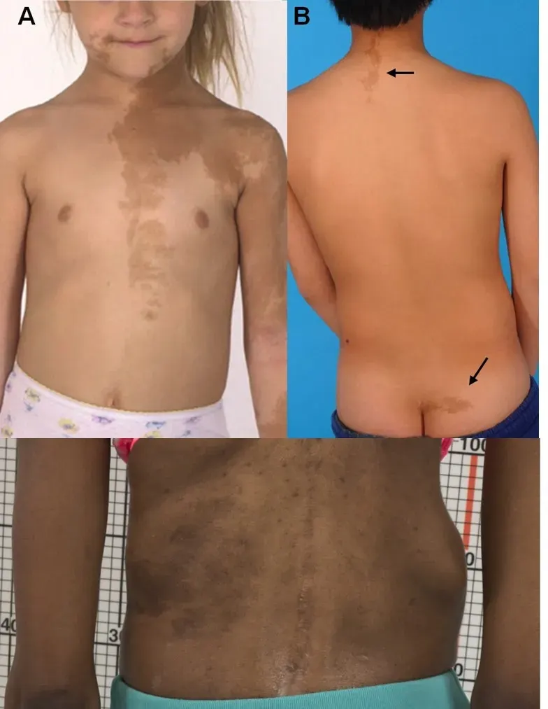 La carte Syndrome de McCune–Albright
