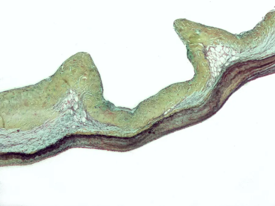 La carte Prolapsus mitral