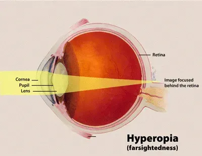 The Visual impairment card