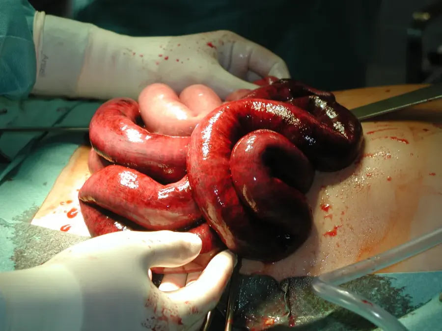 The Ileus card