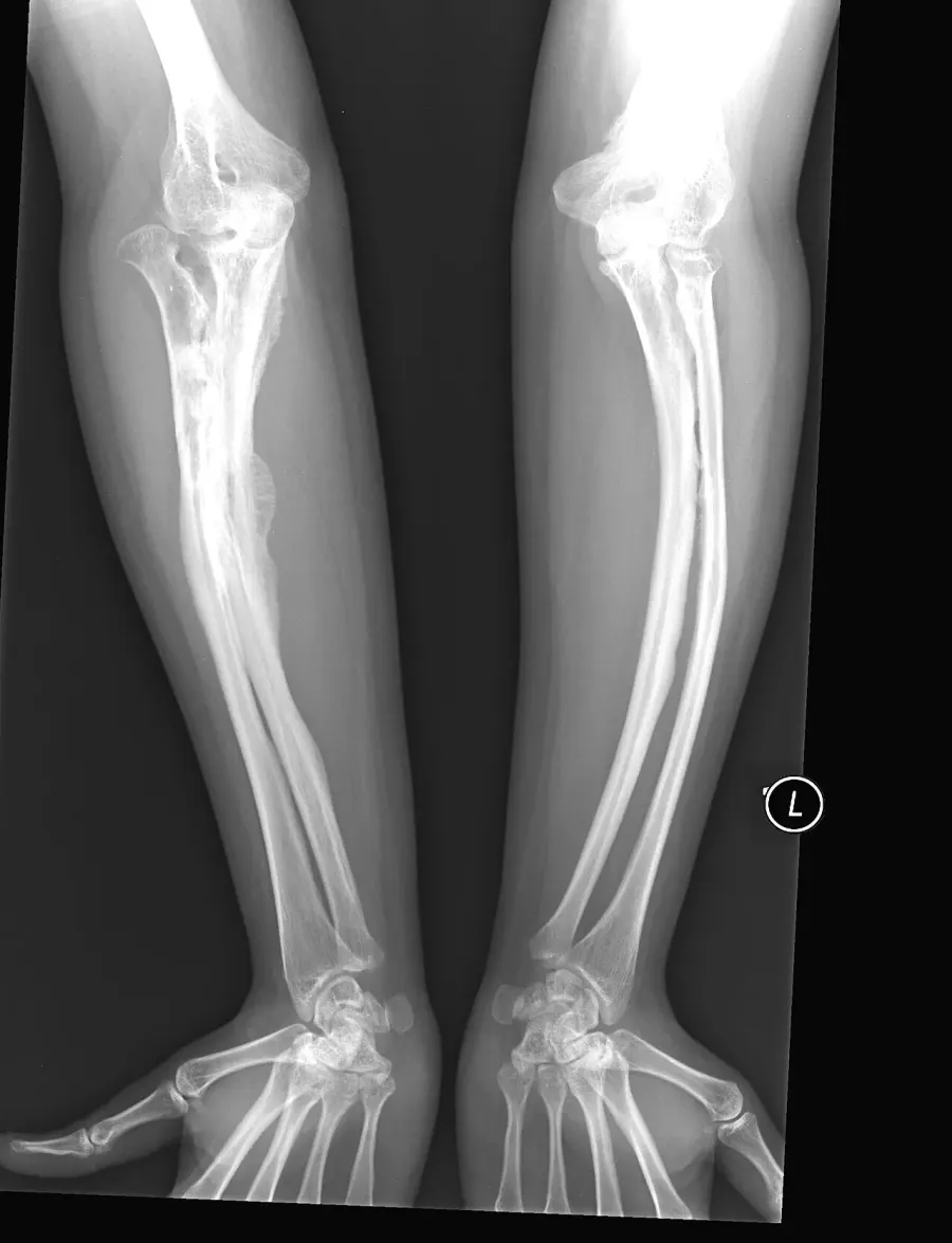 The Osteogenesis imperfecta card