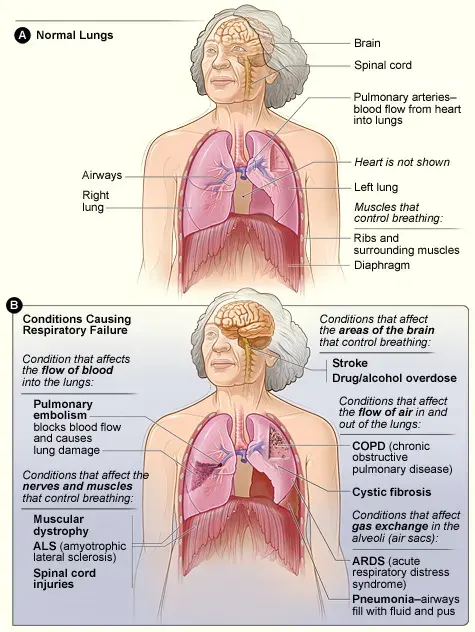 The Respiratory failure card