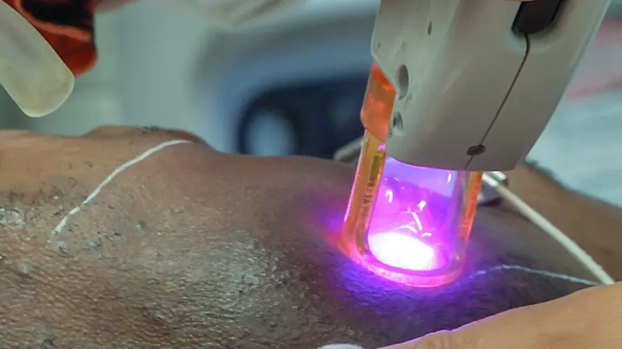 The Laser hair removal card