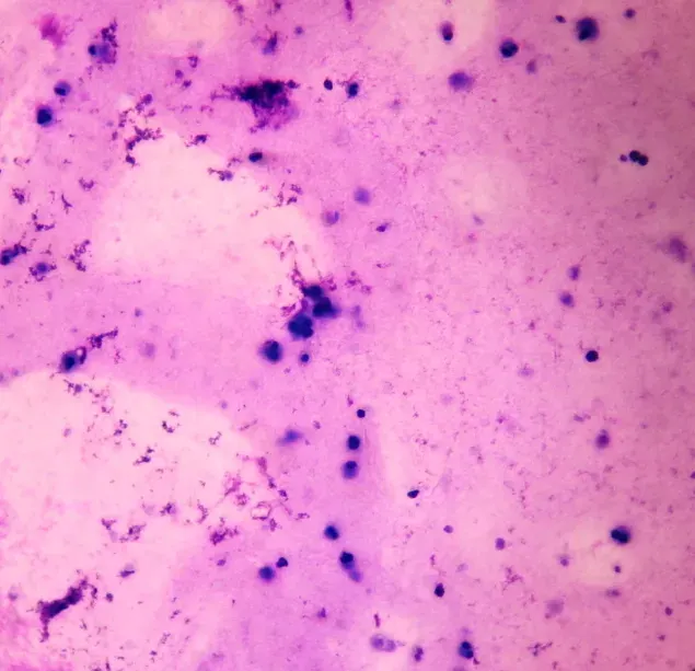 The Azoospermia card