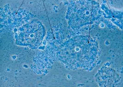 The Bacterial vaginosis card
