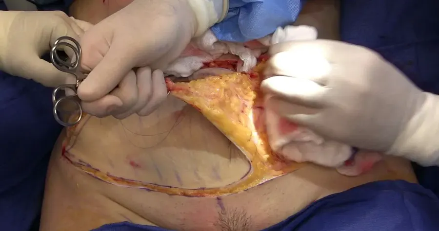 La carte Abdominoplastie