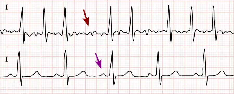 The Atrial fibrillation card