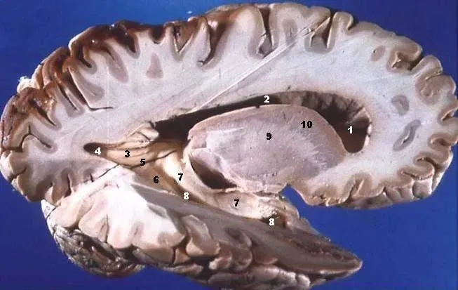 The White matter card