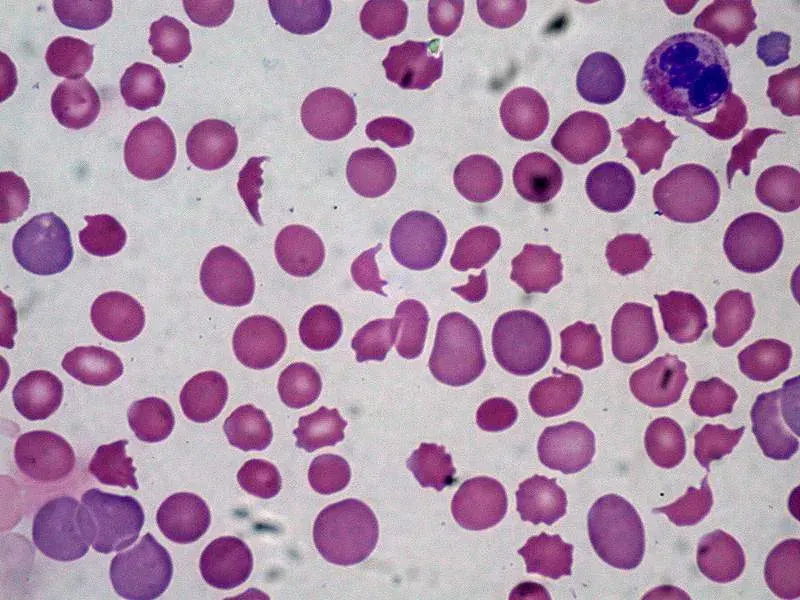 La carte Coagulation intravasculaire disséminée