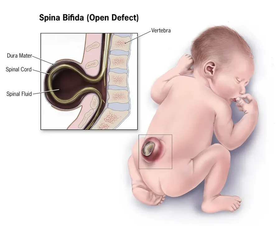 La carte Spina bifida