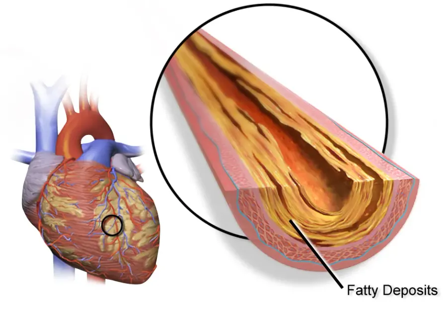 The Coronary artery disease card