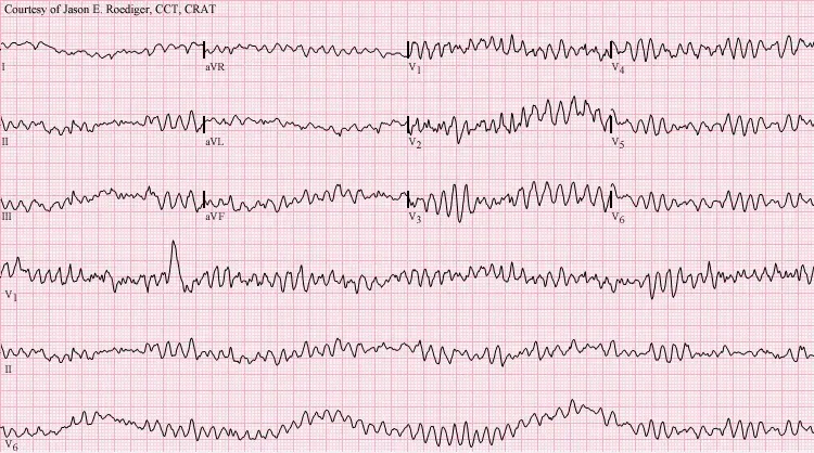 The Ventricular fibrillation card