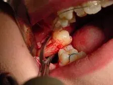 La carte Extraction dentaire