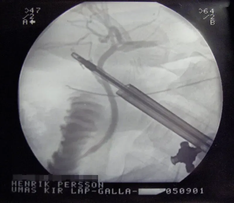 The Bile duct card