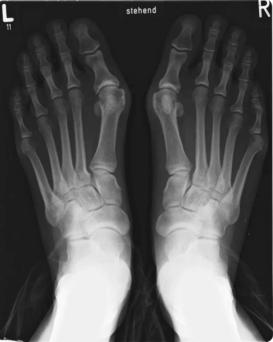 La carte Hallux valgus