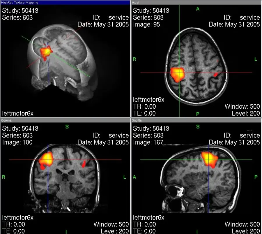 The Functional magnetic resonance imaging card