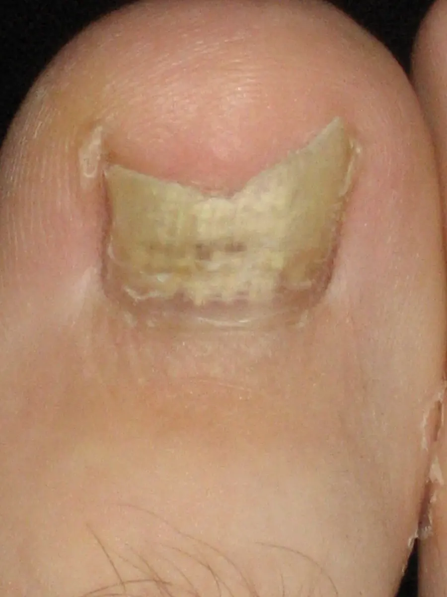 The Onychomycosis card