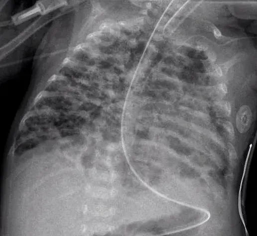 La carte Dysplasie bronchopulmonaire
