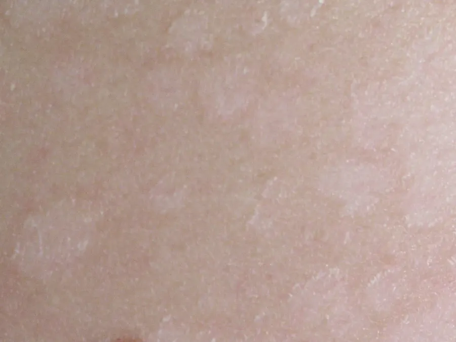The Tinea versicolor card