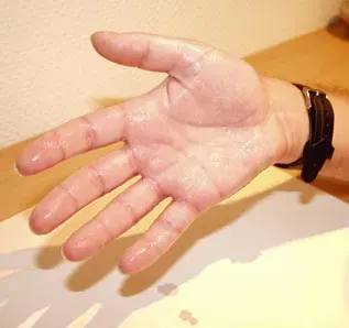 The Hyperhidrosis card