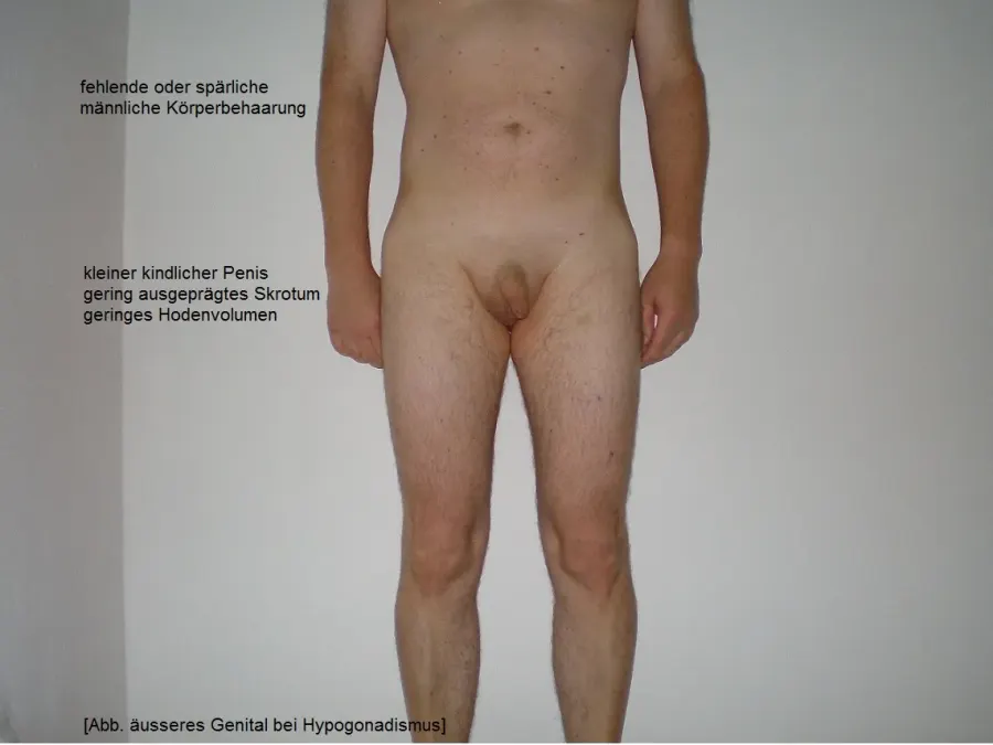 La carte Hypogonadisme