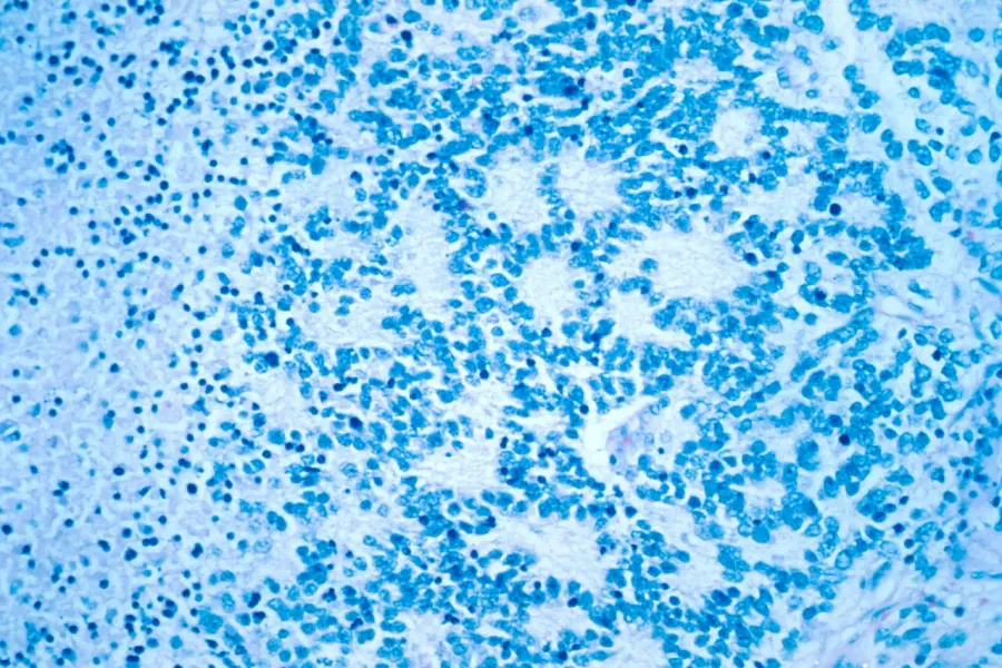The Neuroblastoma card