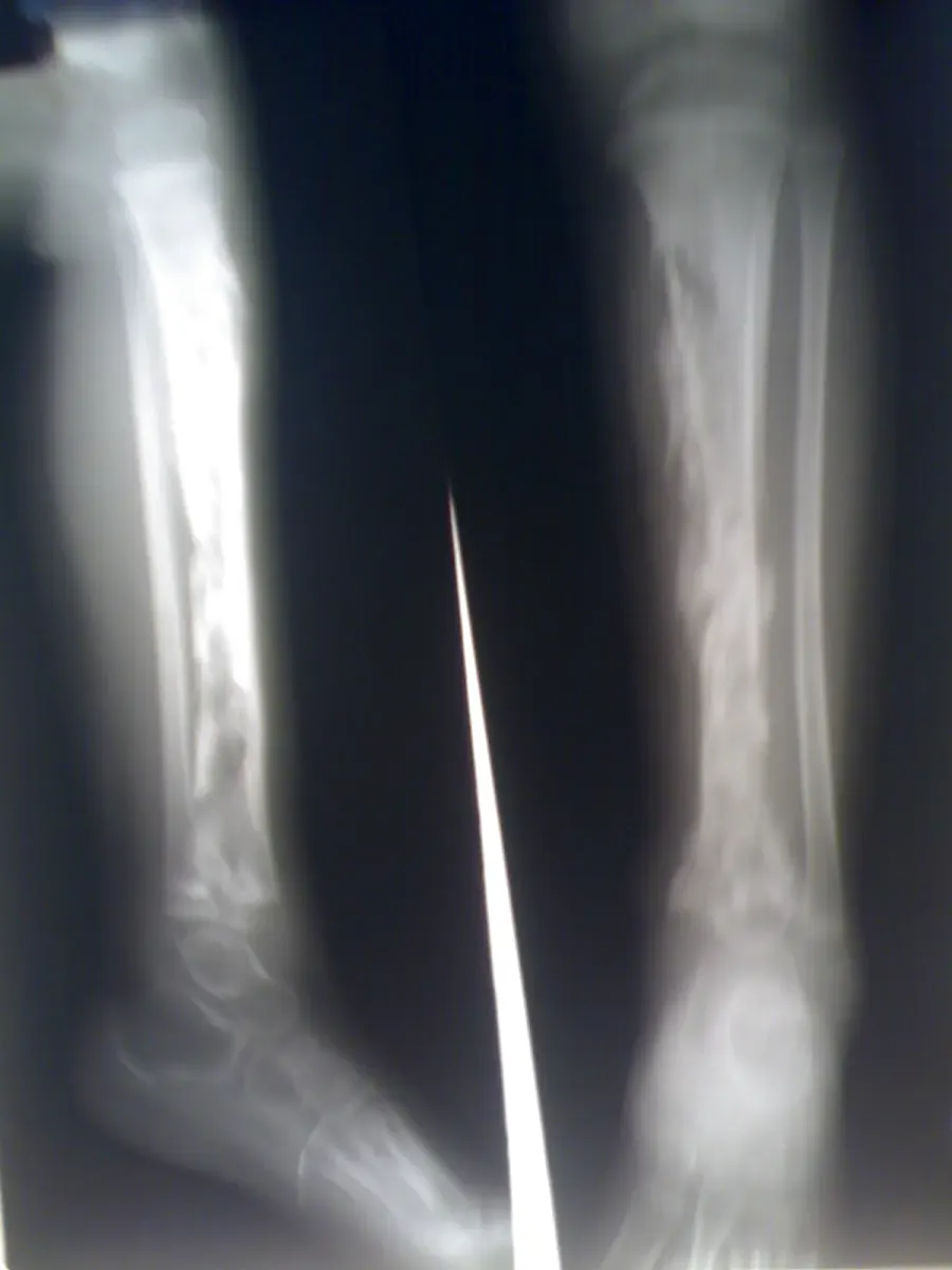 The Osteomyelitis card
