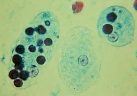 The Amoebiasis card