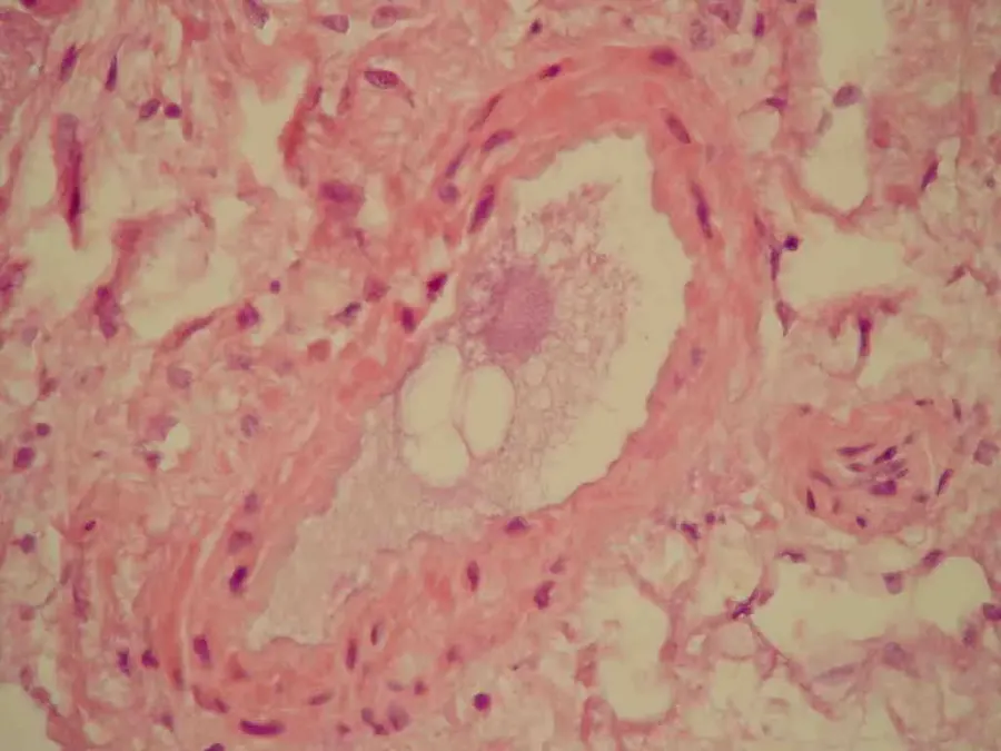 The Fat embolism syndrome card