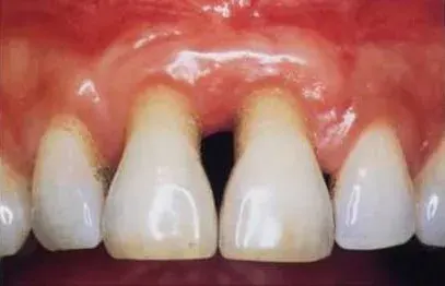 The Gingival recession card
