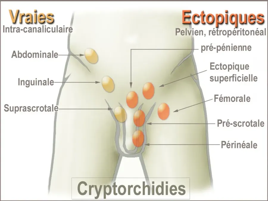 La carte Cryptorchidie