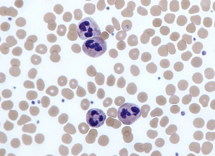 The Leukocytosis card